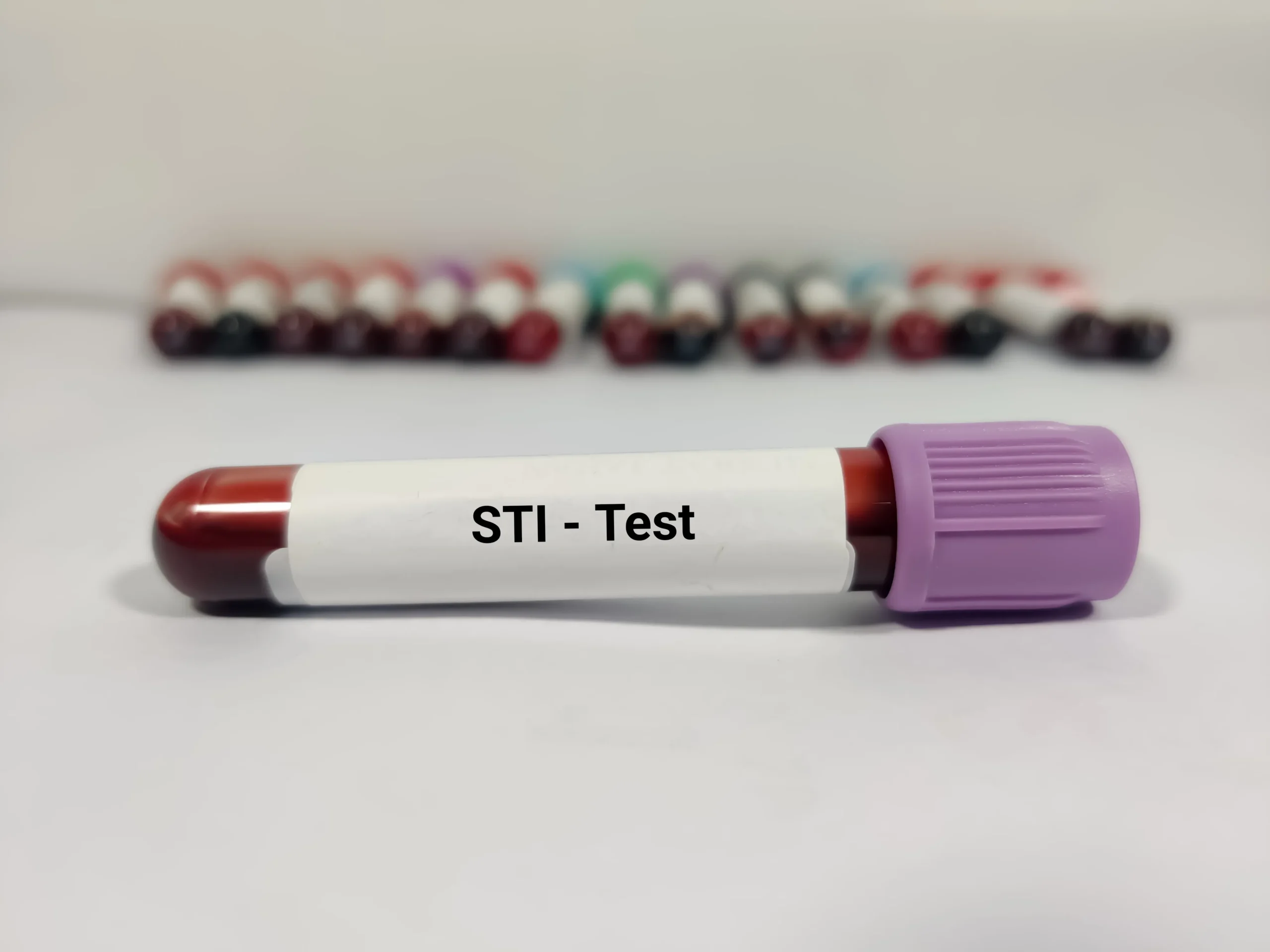 A purple top blood sample tube labeled STI Test ready for processing after an online doctor consultation for STI diagnosis.